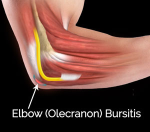elbow olecranon bursitis