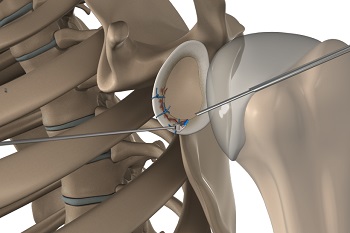 Arthroscopic Bankart Repair Stevenage