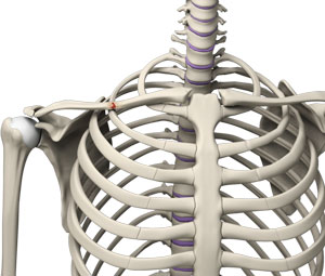 clavicle fracture