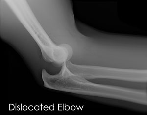 dislocated elbow