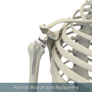 reverse shoulder replacement