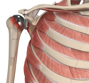 revisional shoulder replacement