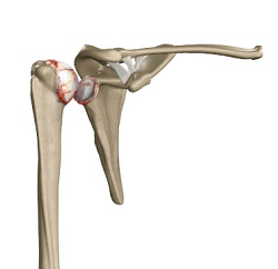 shoulder arthritis