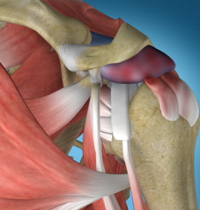 shoulder impingement