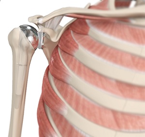 shoulder joint replacement