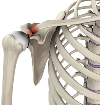 Acromioclavicular Joint (ACJ) Arthritis Stevenage, St Albans