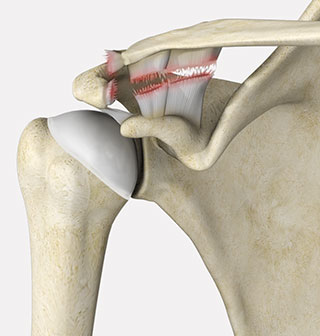 Acromioclavicular Joint Separation St Albans, Stevenage, Welwyn City