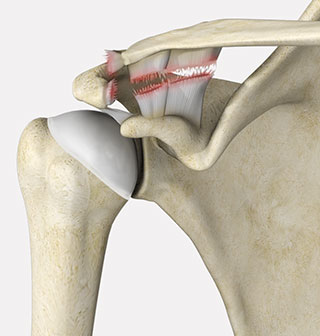 https://www.shoulderandelbowspecialist.co.uk/images/acromioclavicular-joint-separation.jpg