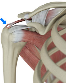 Calcific Tendonitis Hitchin  Shoulder Pain Treatments St Albans