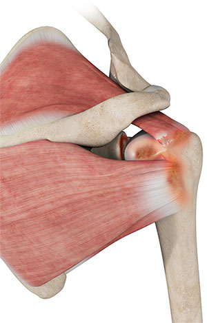 Rotator Cuff Tear Arthropathy St Albans